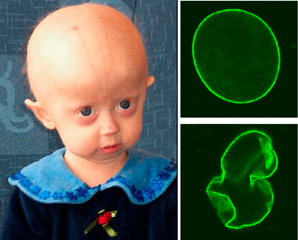 bt1505_cynthia_Hutchinson-Gilford_Progeria_Syndrome