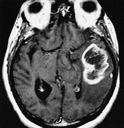 MRI image of a glioblastoma multiforme. (Source: Wikimedia/The Armed Forces Institute of Pathology)