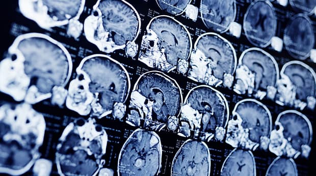 MRI scan of a patient with a tumor in the brain stem. Neurosurgery, cancer, surgery.