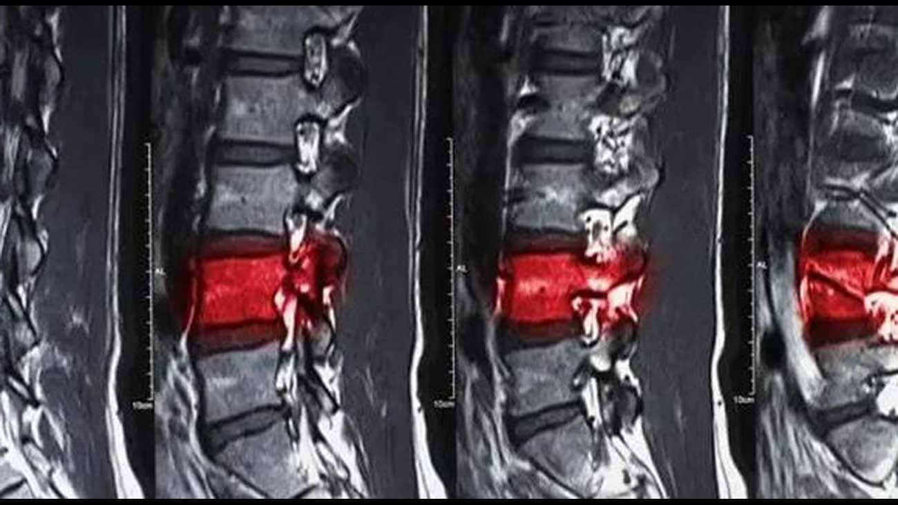 Spinal Cord Injuries Xray Image | New Stem Cell-Based I Tiral