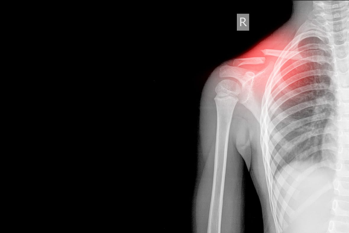 Right Shoulder Xray AP views Showing fracture middle cavicle on red mark,Medical image concept. and coppy space.